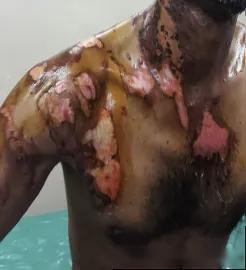 DIPHOTERINE敵腐特靈溶液印度塔拉普爾工業(yè)區(qū)化學(xué)灼傷效果評估1